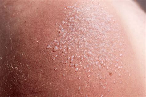 Sun Blisters: How to Treat Them and How Long They Last